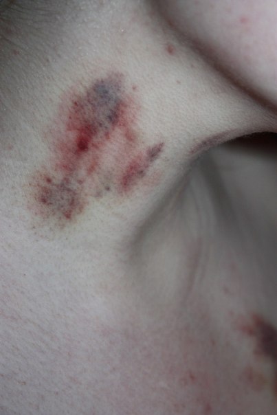 я не болен её