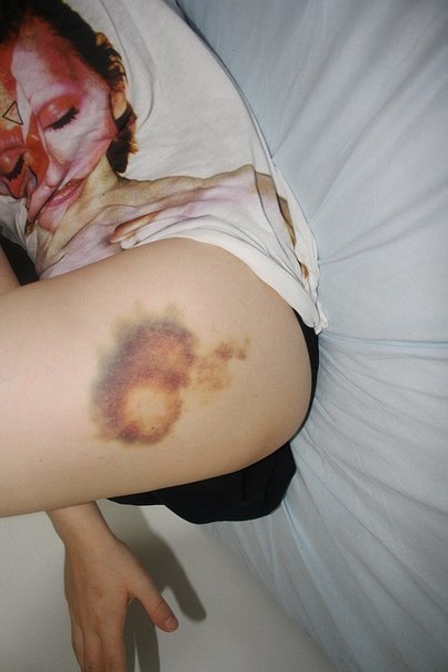 ссадины кровоточат