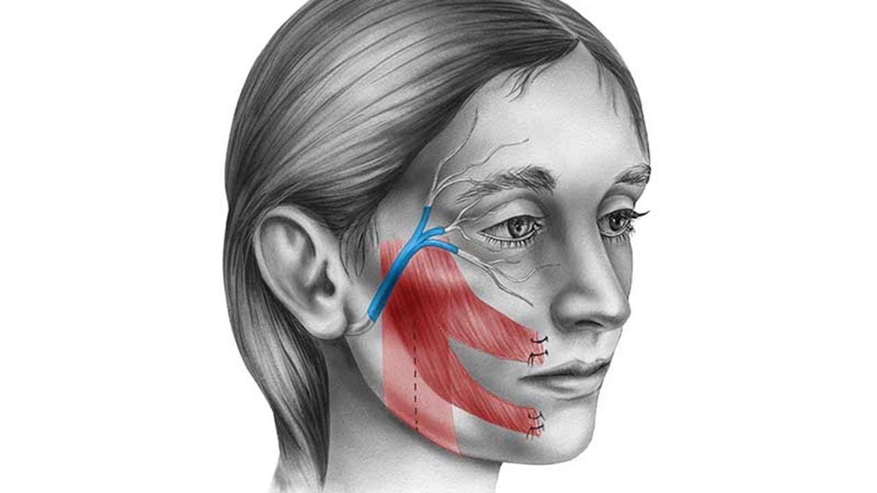 May и Schaitkin (2003) [May m, Schaitkin BM. Facial Paralysis Rehabilitation techniques. N. Y.: Thieme